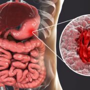 if gastric distention begins to make positive